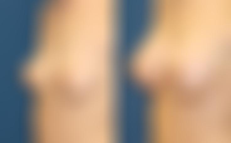 Before and after photo of an actual Breast Augmentation patient.