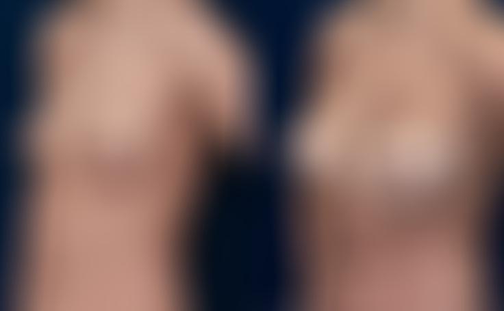 Before and after photo of an actual Breast Augmentation patient.