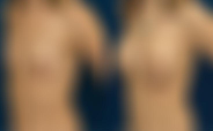 Before and after photo of an actual Breast Augmentation patient.
