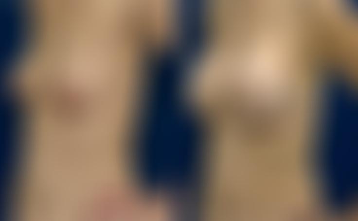 Before and after photo of an actual Breast Augmentation patient.
