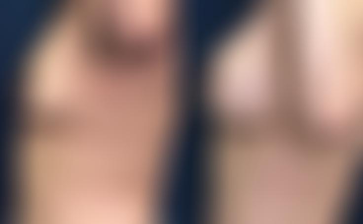 Before and after photo of an actual Breast Augmentation patient.