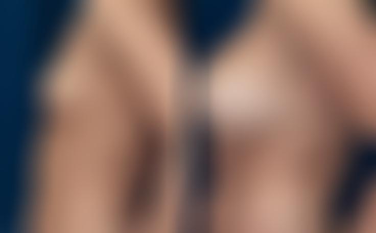 Before and after photo of an actual Breast Augmentation patient.