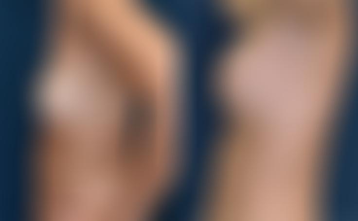 Before and after photo of an actual Breast Augmentation patient.
