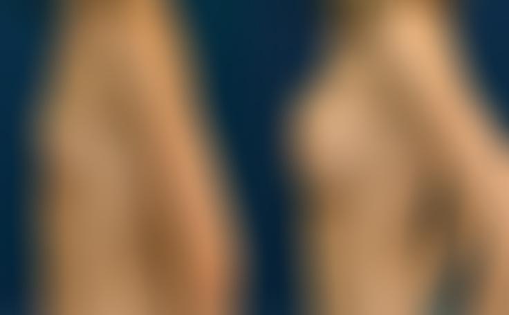 Before and after photo of an actual Breast Augmentation patient.