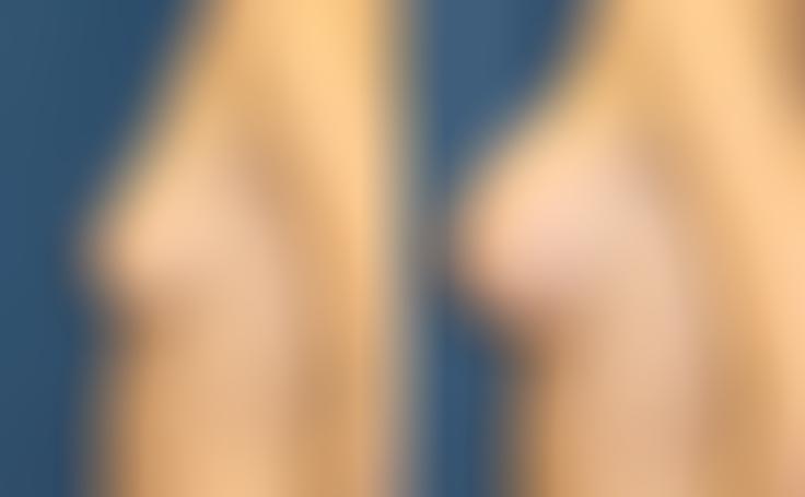 Before and after photo of an actual Breast Augmentation patient.