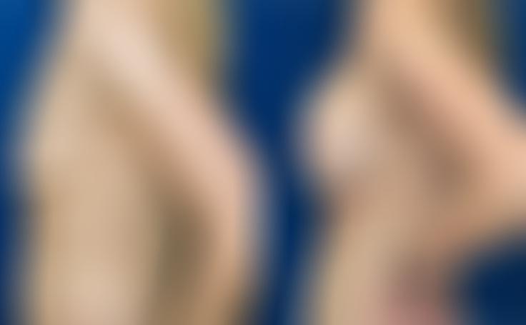 Before and after photo of an actual Breast Augmentation patient.