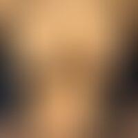 photo of a patient 9 years after her breast augmentation surgery