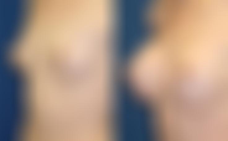 Before and after photo of an actual Breast Augmentation patient.