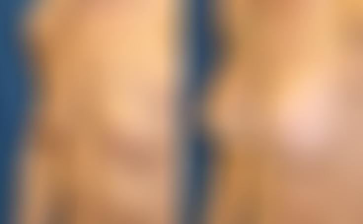 Before and after photo of an actual Breast Augmentation patient.