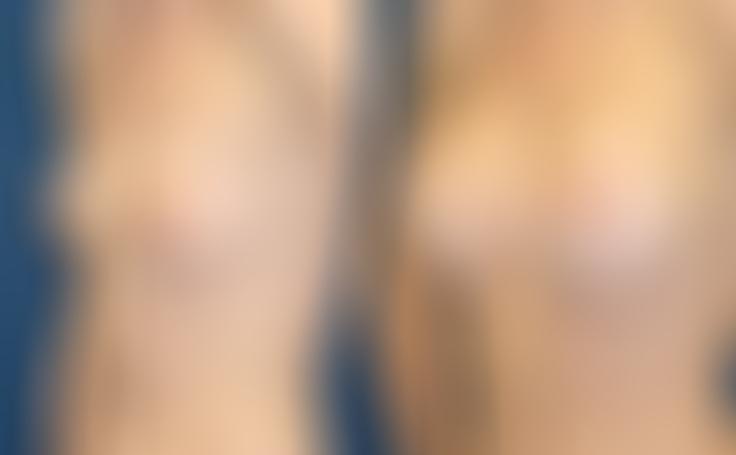 Before and after photo of an actual Breast Augmentation patient.