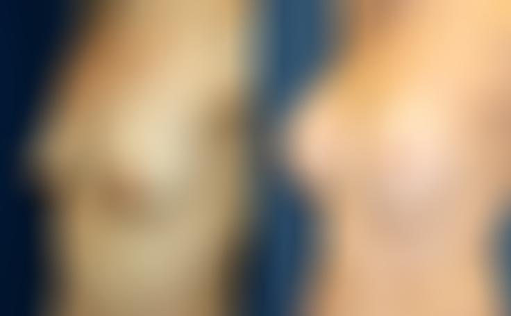 Before and after photo of an actual Breast Augmentation patient.