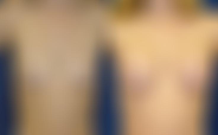 Before and after photo of an actual Breast Augmentation patient.