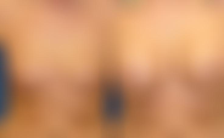 Before and after photo of an actual Breast Augmentation patient.