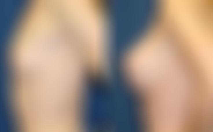 Before and after photo of an actual Breast Augmentation patient.