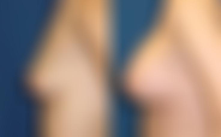 Before and after photo of an actual Breast Augmentation patient.