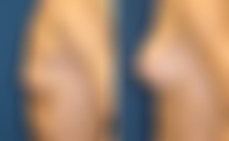 Before and after photo of an actual Breast Augmentation patient.