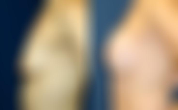 Before and after photo of an actual Breast Augmentation patient.