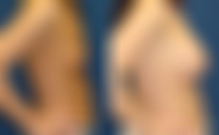 Before and after photo of an actual Breast Augmentation patient.
