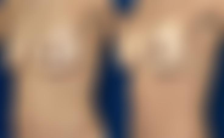 Before and after photo of an actual Breast Lift with Implants patient.