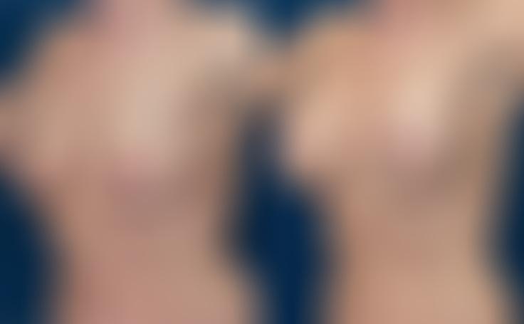 Before and after photo of an actual Breast Lift with Implants patient.