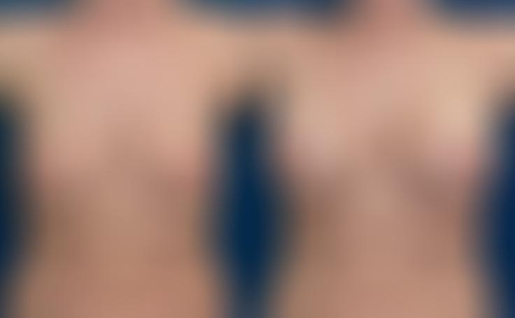 Before and after photo of an actual Breast Lift with Implants patient.