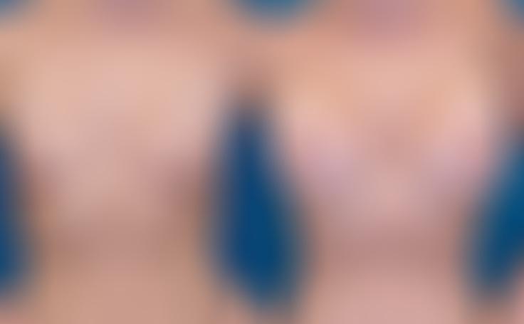 Before and after photo of an actual Breast Lift with Implants patient.