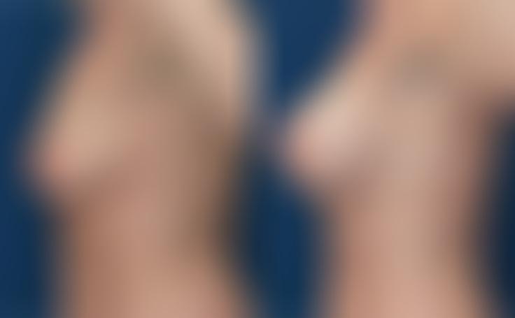 Before and after photo of an actual Breast Lift with Implants patient.