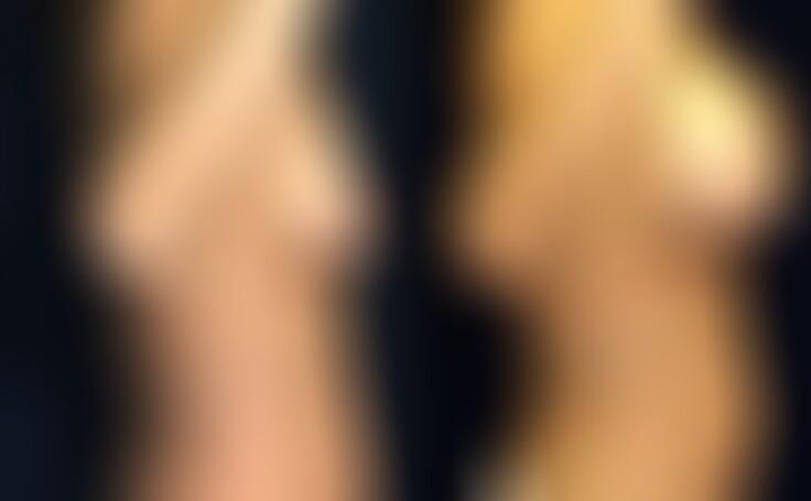 Before and after photo of an actual Breast Lift with Implants patient.