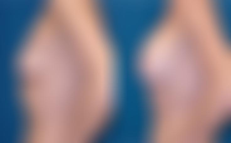 Before and after photo of an actual Breast Lift with Implants patient.