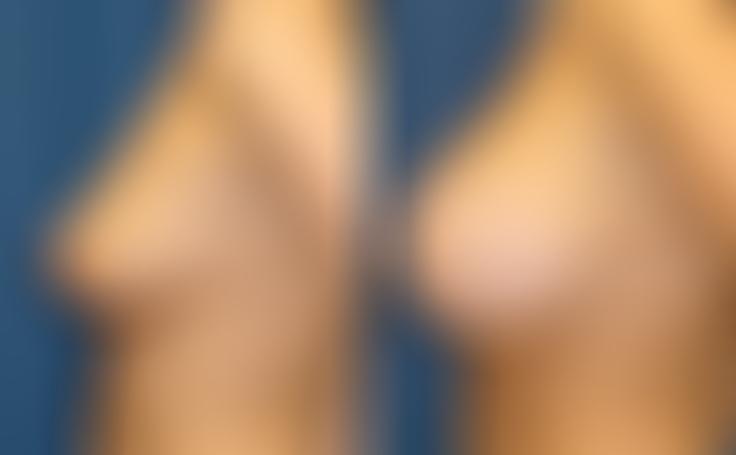 Before and after photo of an actual Breast Lift with Implants patient.