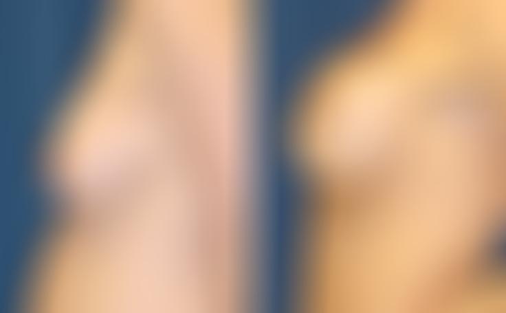 Before and after photo of an actual Breast Lift with Implants patient.