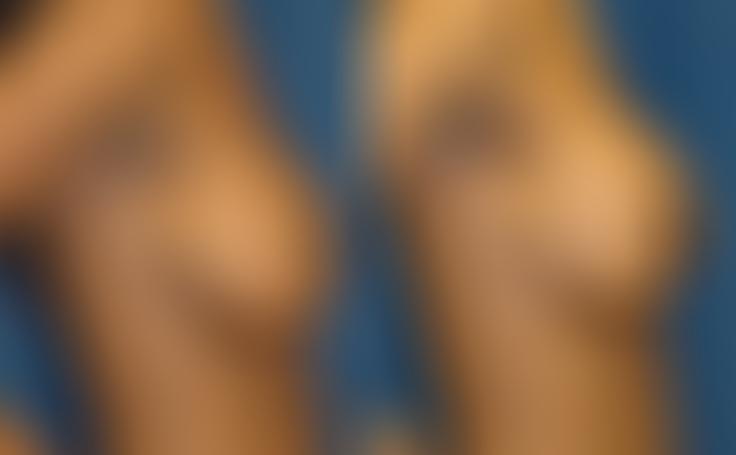Before and after photo of an actual Breast Lift with Implants patient.