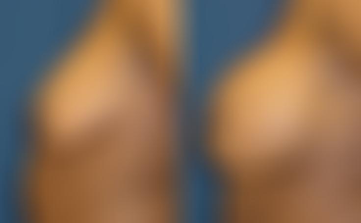 Before and after photo of an actual Breast Augmentation patient.