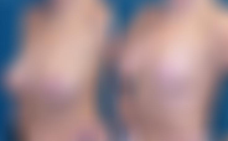 Before and after photo of an actual Breast Reduction patient.