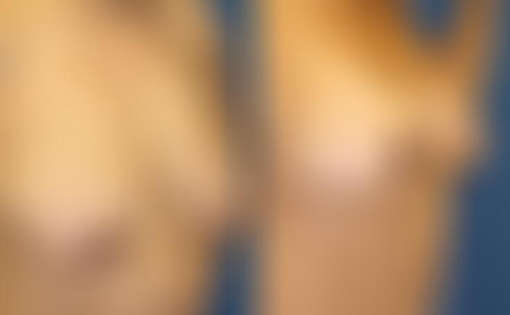 Before and after photo of an actual Breast Reduction patient.