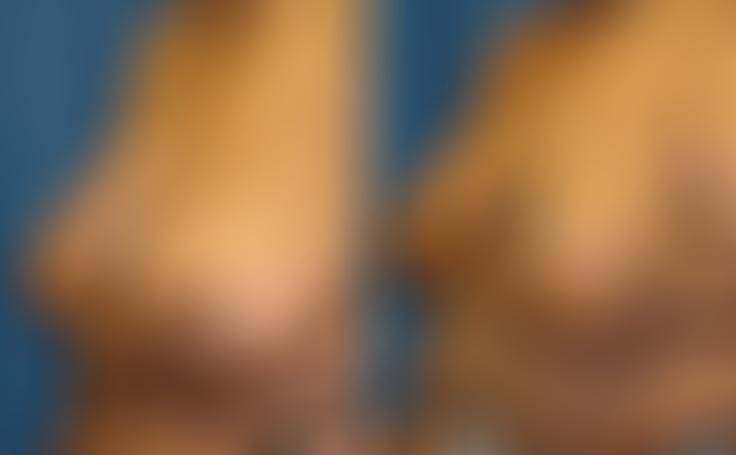Before and after photo of an actual Breast Reduction patient.
