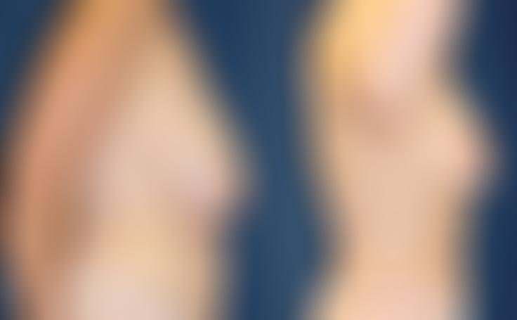 Before and after photo of an actual Breast Reduction patient.