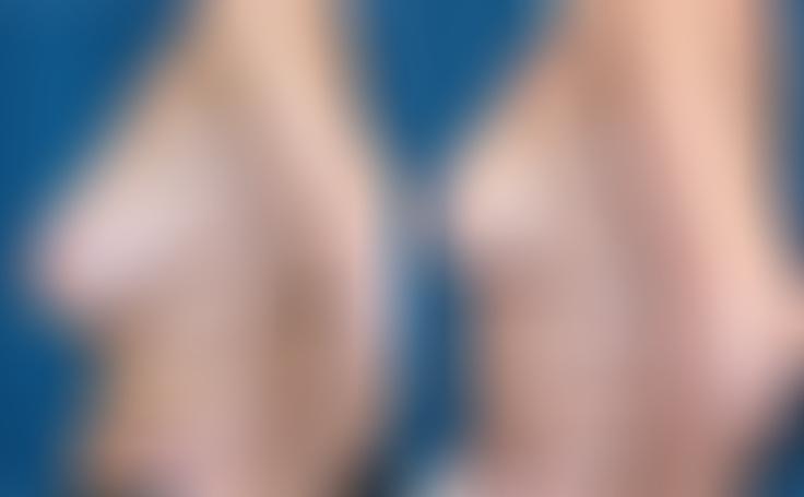 Before and after photo of an actual Breast Reduction patient.