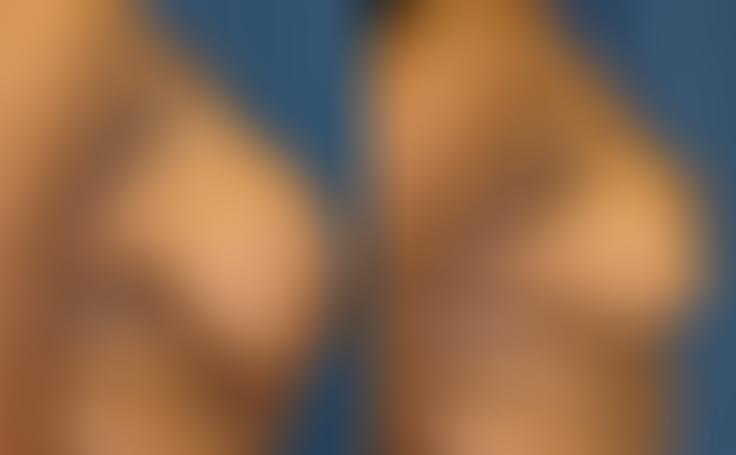 Before and after photo of an actual Breast Reduction patient.