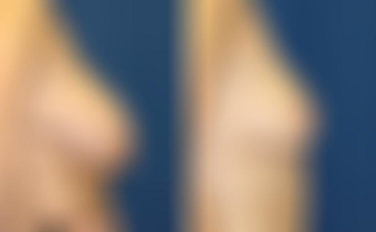 Before and after photo of an actual Breast Reduction patient.