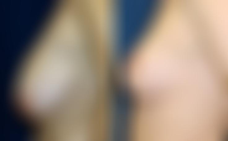 Before and after photo of an actual Breast Reduction patient.