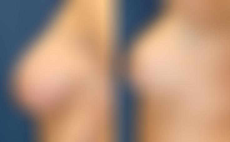 Before and after photo of an actual Breast Reduction patient.