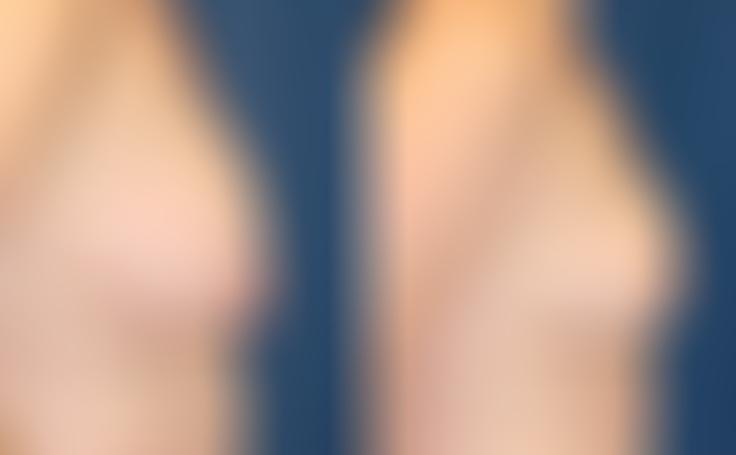 Before and after photo of an actual Breast Reduction patient.