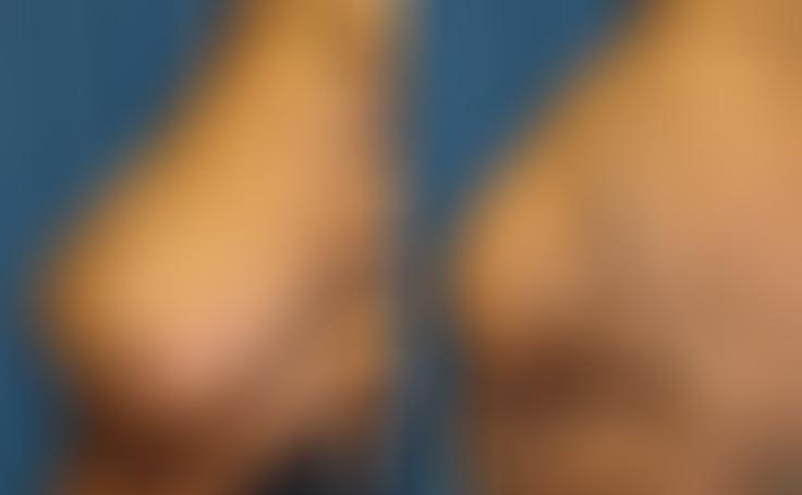 Before and after photo of an actual Breast Reduction patient.