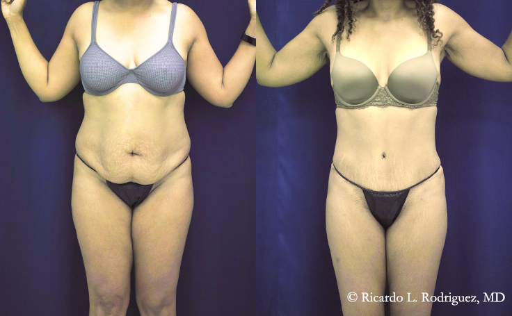 tummy tuck with liposuction patient before and after her procedure