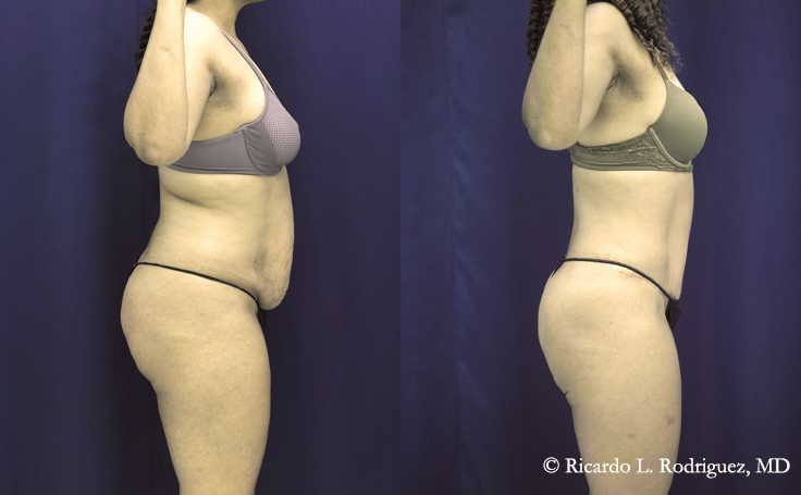 tummy tuck with liposuction patient before and after