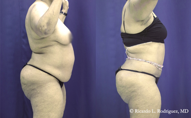 before and after a tummy tuck with liposuction patient photos