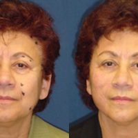 A collage of photos of a patient before & after a Thread lift.