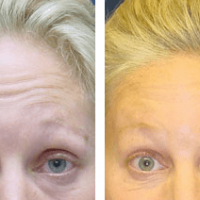 A collage of photos of a patient's forehead, showing the patient before and after a botox treatment.