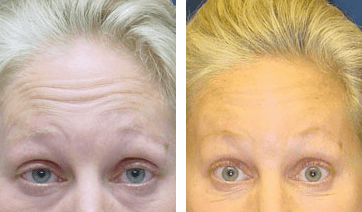 A collage of photos of a patient's forehead, showing the patient before and after a botox treatment.